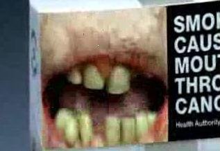 Последствия курения для зубы